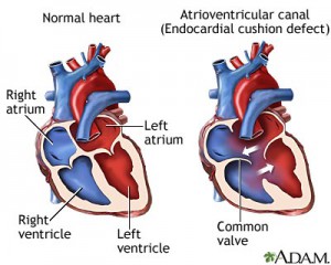 atrioventricular-canal-endocardial-cushion-defect